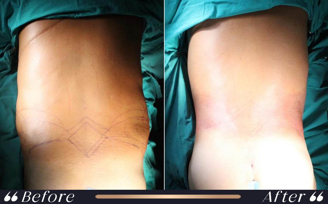 Liposuction vs Tummy Tuck for Belly Fat belly fat treatment liposuction vs tummy tuck