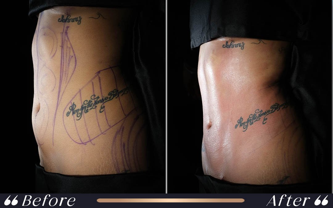 Liposuction Recovery Before Flying Liposuction recovery before flying after surgery