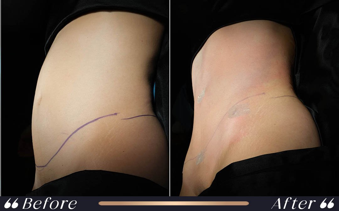 Flying After Liposuction Flying after liposuction and international patient recovery