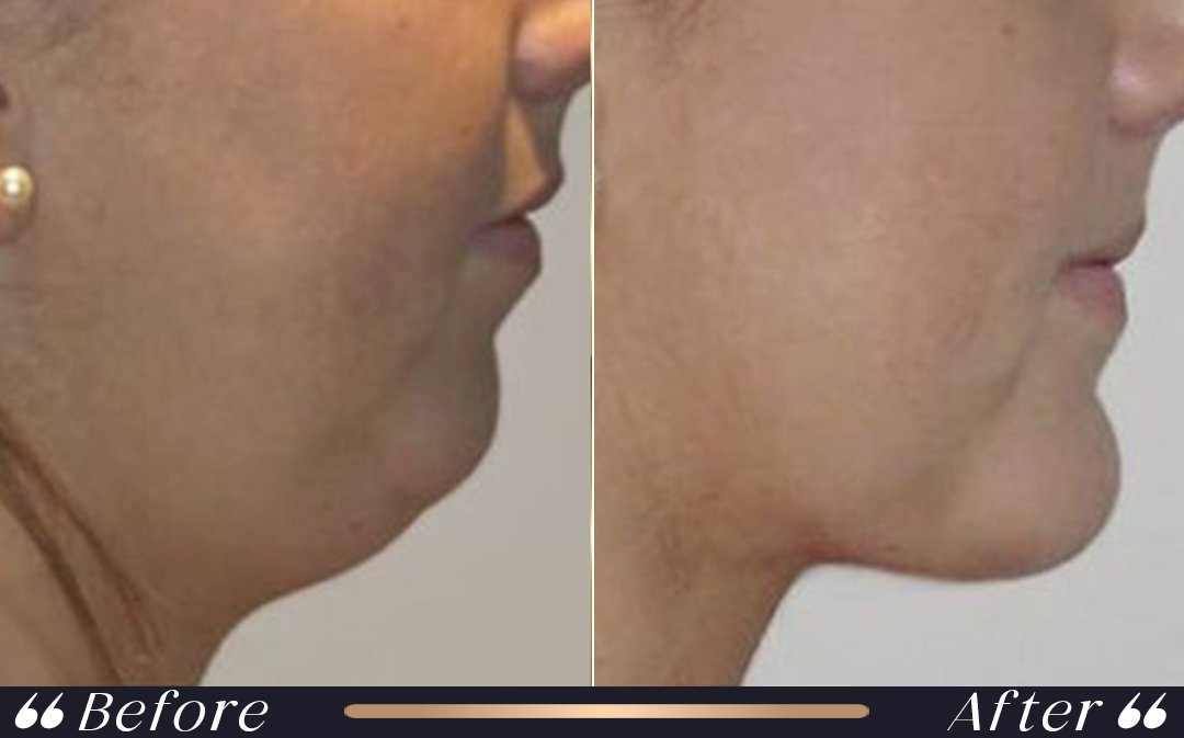 Liposuction in Turkey Recovery Planning Liposuction in Turkey recovery planning at Yesilkoy Clinic