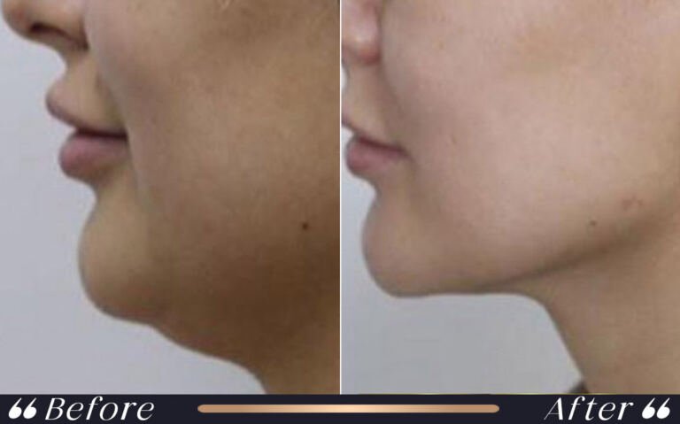 liposuction_15