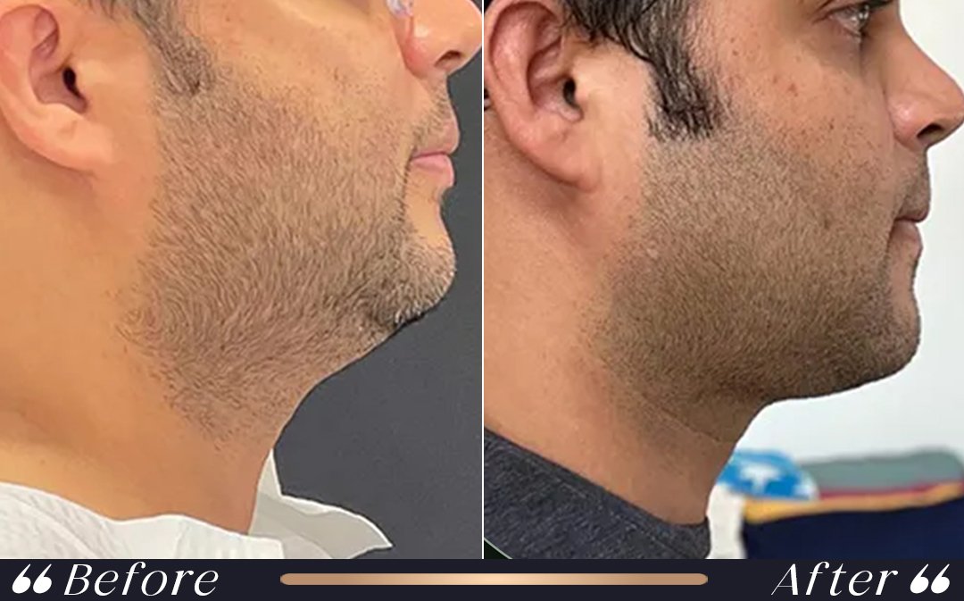 Liposuction vs Tummy Tuck at Yesilkoy Clinic liposuction vs tummy tuck professional treatment planning at Yesilkoy Clinic