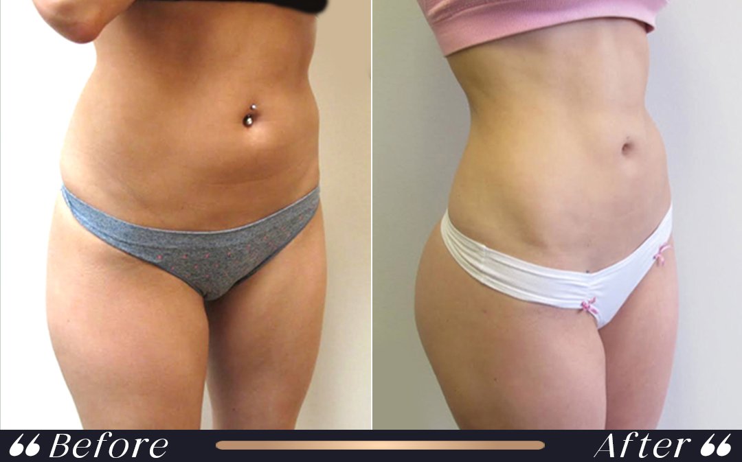 When Can I Fly After Liposuction? When can I fly after liposuction at Yesilkoy Clinic