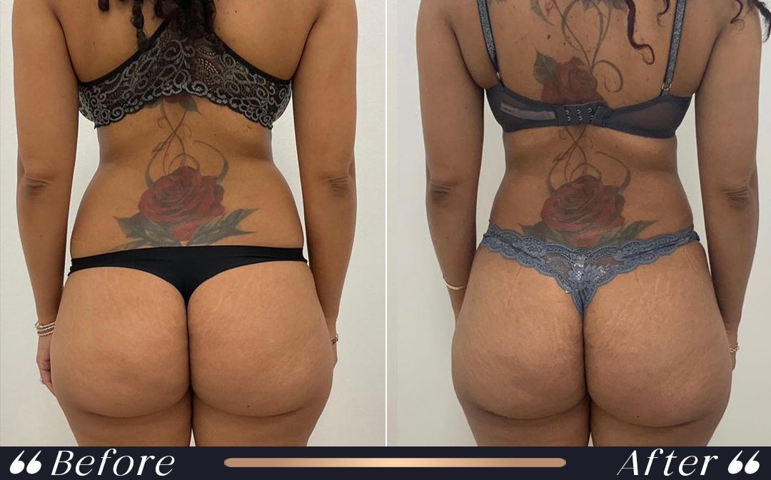 Liposuction at Yesilkoy Clinic