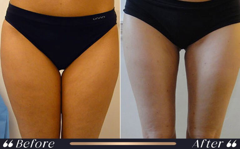 liposuction_24