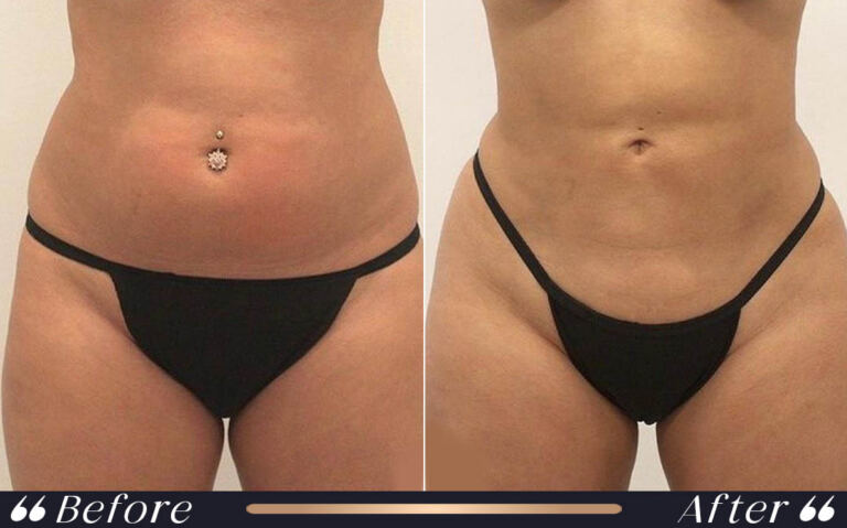 liposuction_3