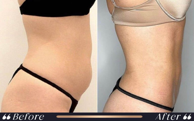 liposuction_5