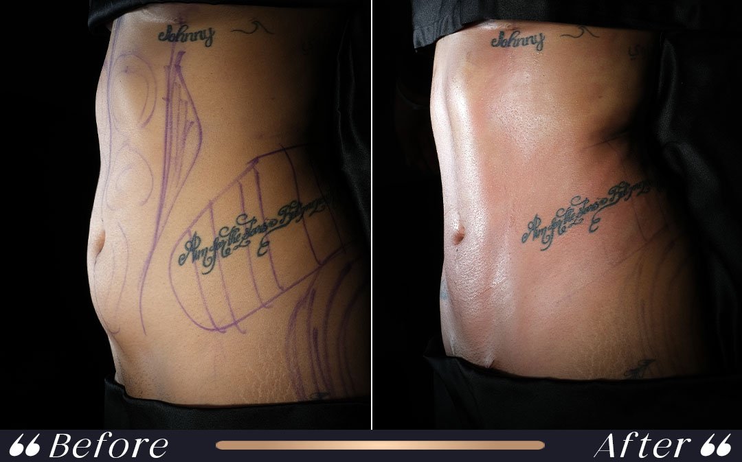Tummy Tuck at Yesilkoy Clinic