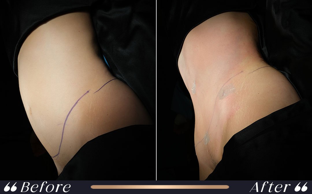 Tummy Tuck at Yesilkoy Clinic