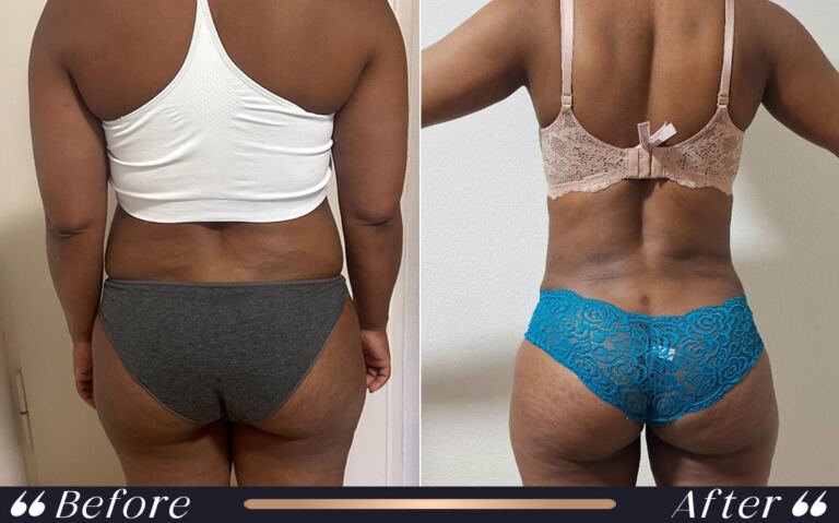 liposuction_7