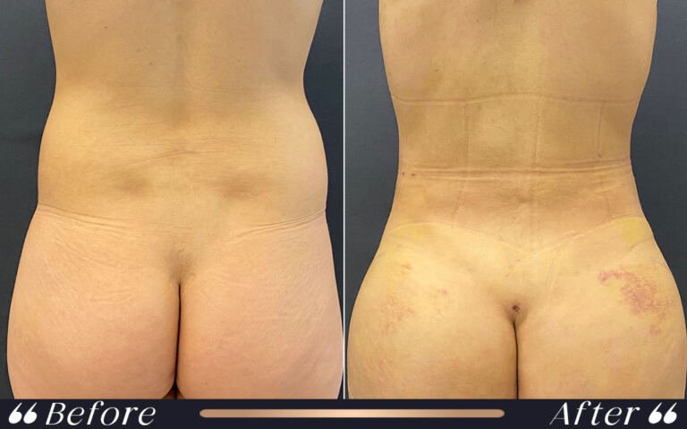 liposuction_8