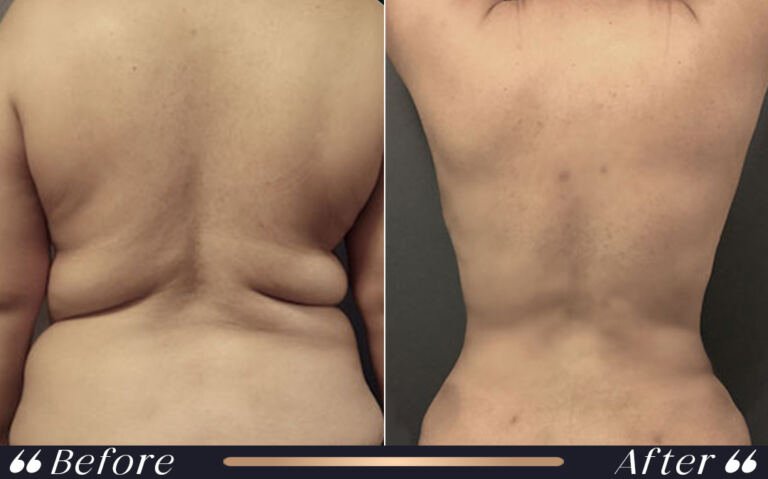 liposuction_9