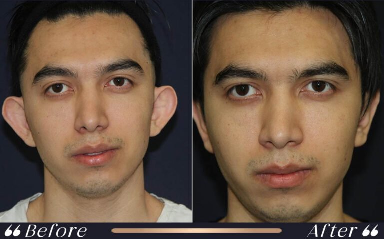 otoplasty