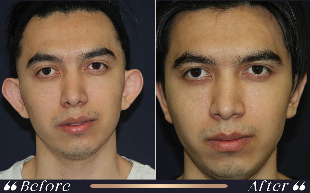 Otoplasty Before and After