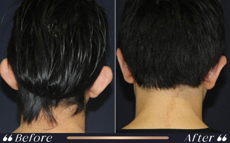 otoplasty_1