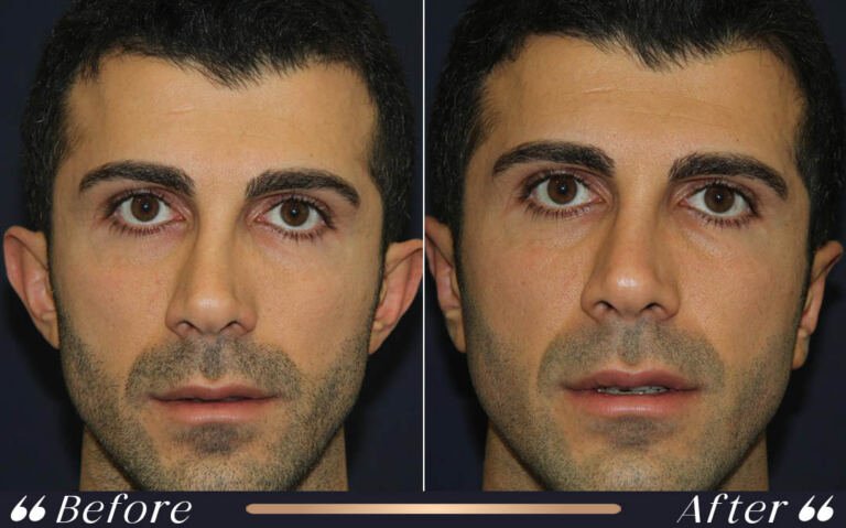otoplasty_2