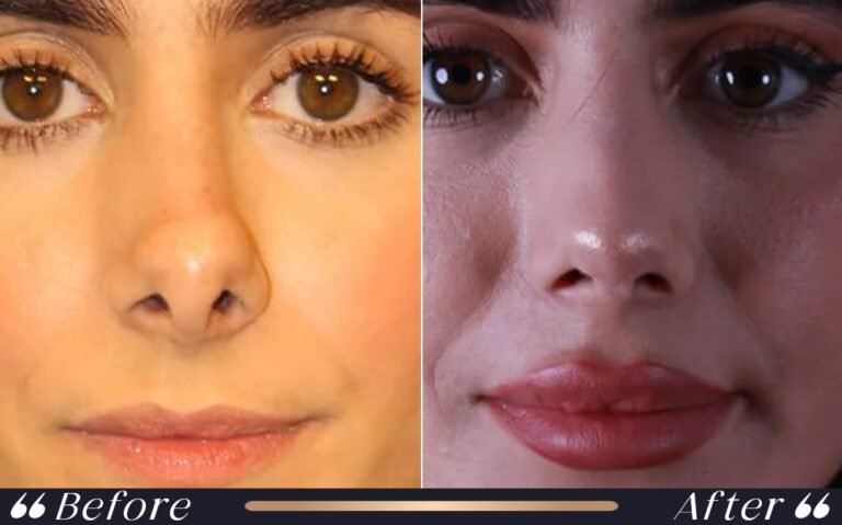revisionrhinoplasty