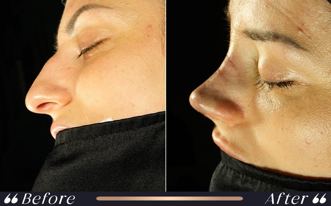 Rhinoplasty Before and After