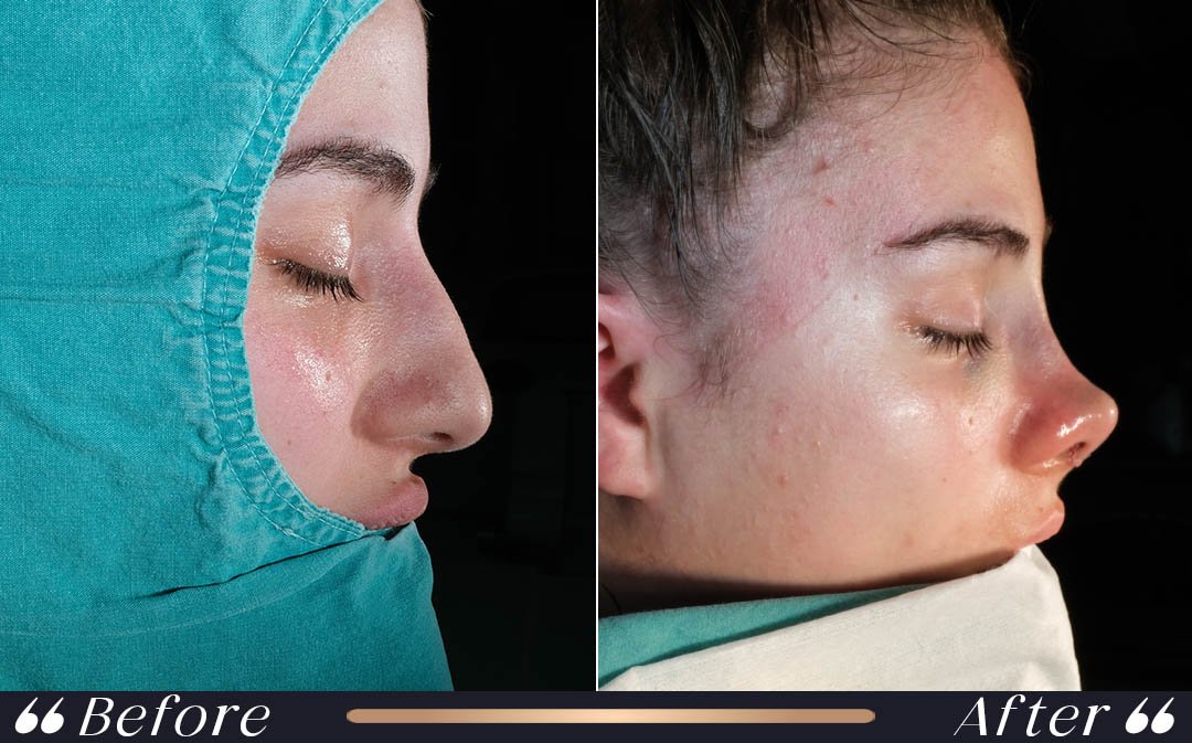 Rhinoplasty Result 2