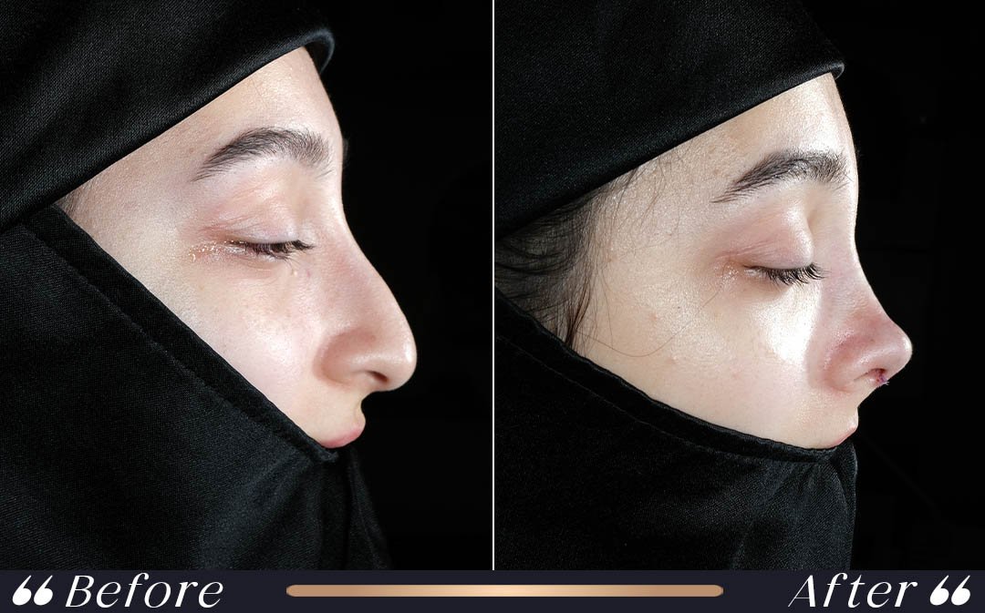 Rhinoplasty Result 4