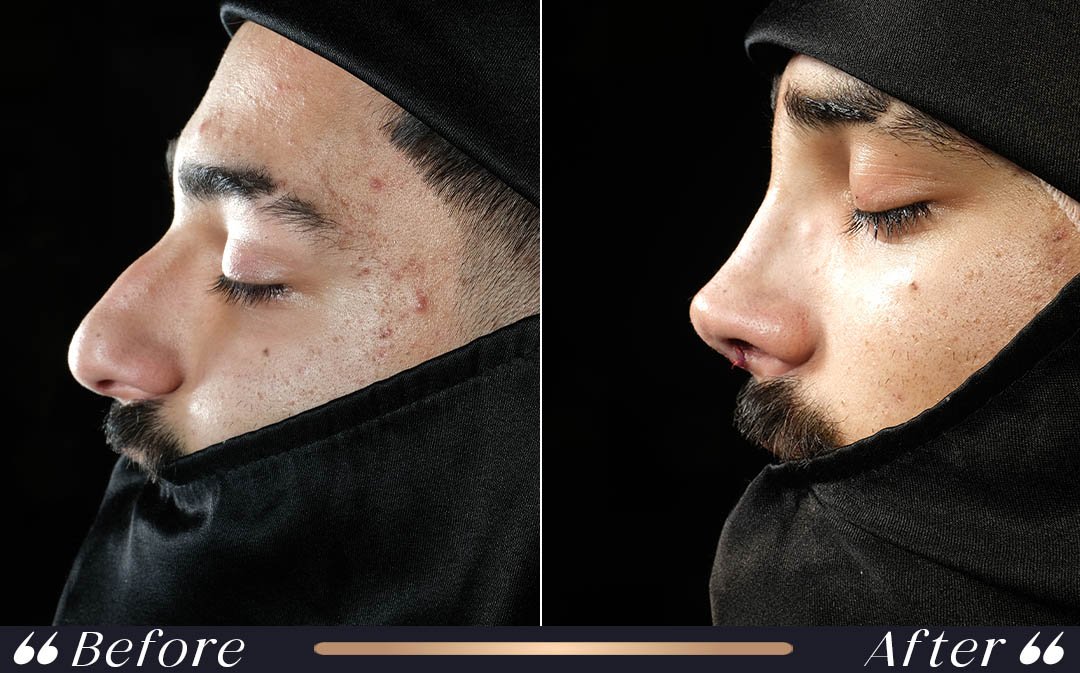 When can I fly after rhinoplasty two week recovery timeline