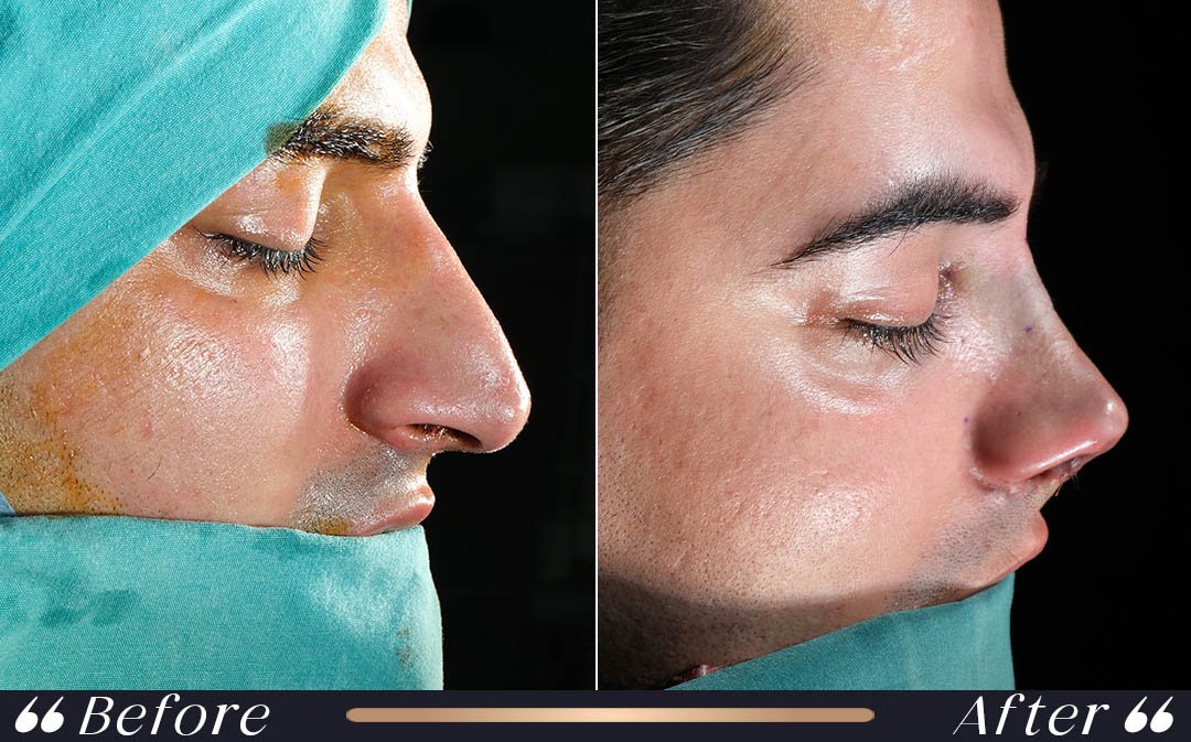 Flying after rhinoplasty international patient recovery Istanbul