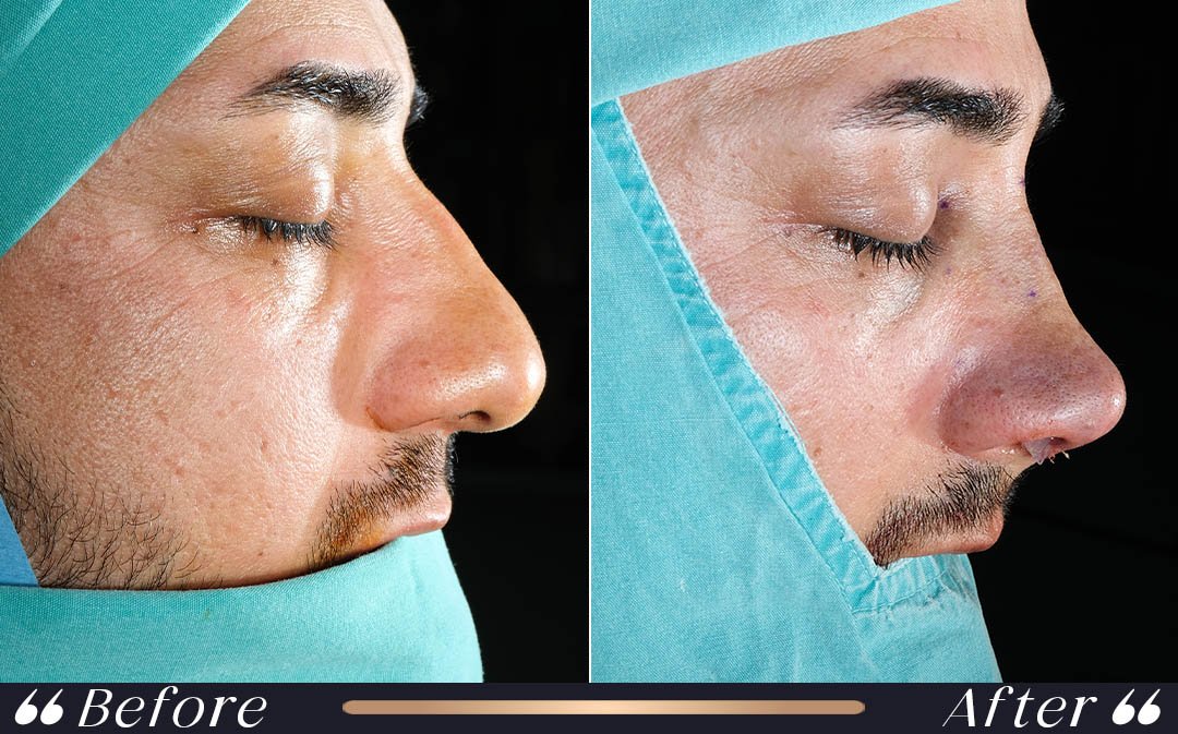 Rhinoplasty recovery week by week after nose surgery at Yeşilköy Clinic