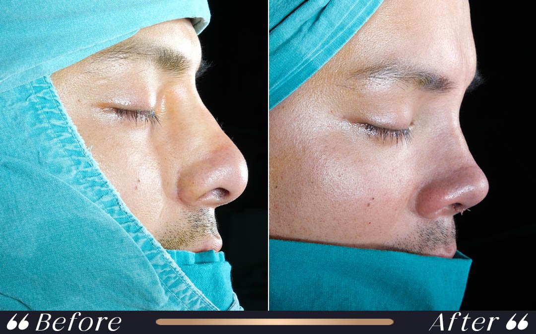 Rhinoplasty recovery week 1 and week 2 healing process