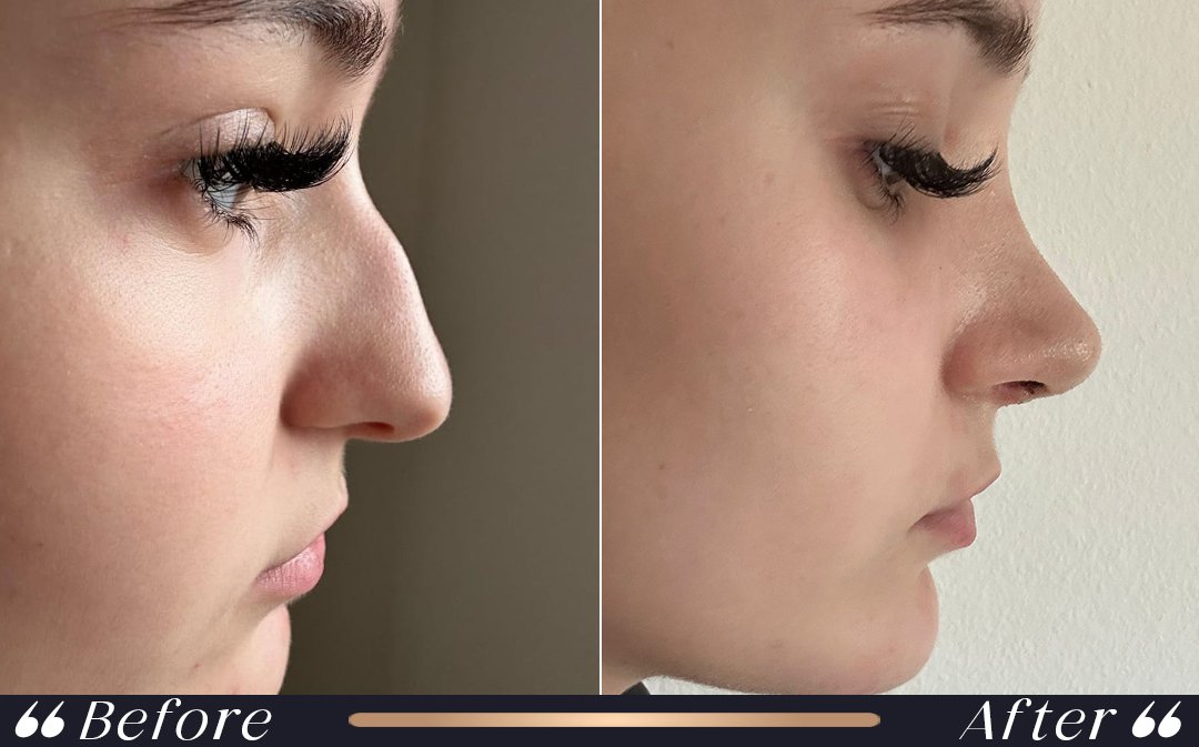 Septoplasty vs Rhinoplasty at Yesilkoy Clinic professional septoplasty vs rhinoplasty planning at Yesilkoy Clinic