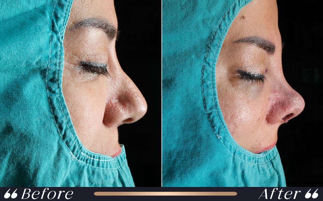 when can i wear glasses after rhinoplasty safe recovery