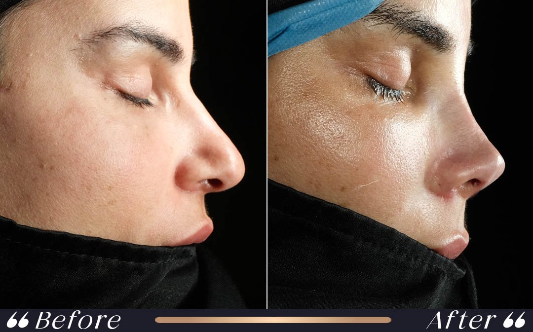 Rhinoplasty (Nose Surgery) at Yesilkoy Clinic