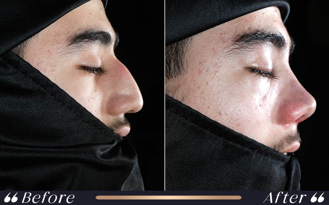 Rhinoplasty (Nose Surgery) at Yesilkoy Clinic