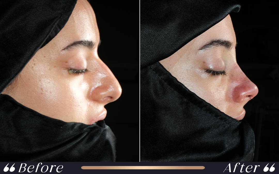 Rhinoplasty (Nose Surgery) at Yesilkoy Clinic