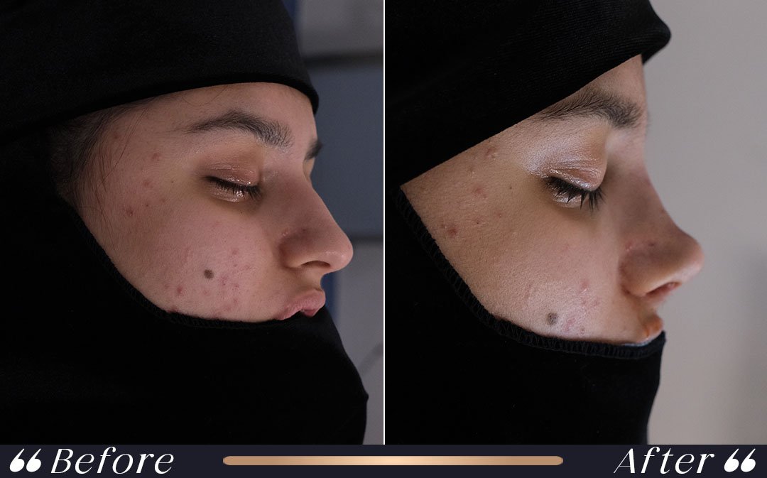what to eat after rhinoplasty recovery nutrition
