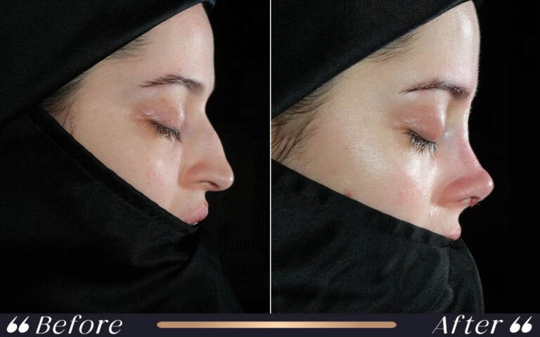 rhinoplasty_21