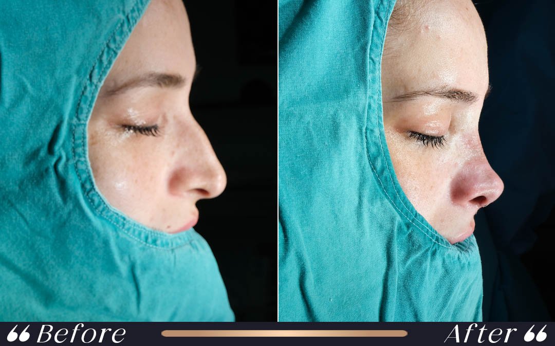 professional what to eat after rhinoplasty recovery planning at Yesilkoy Clinic