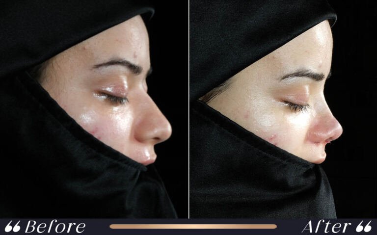 rhinoplasty_4