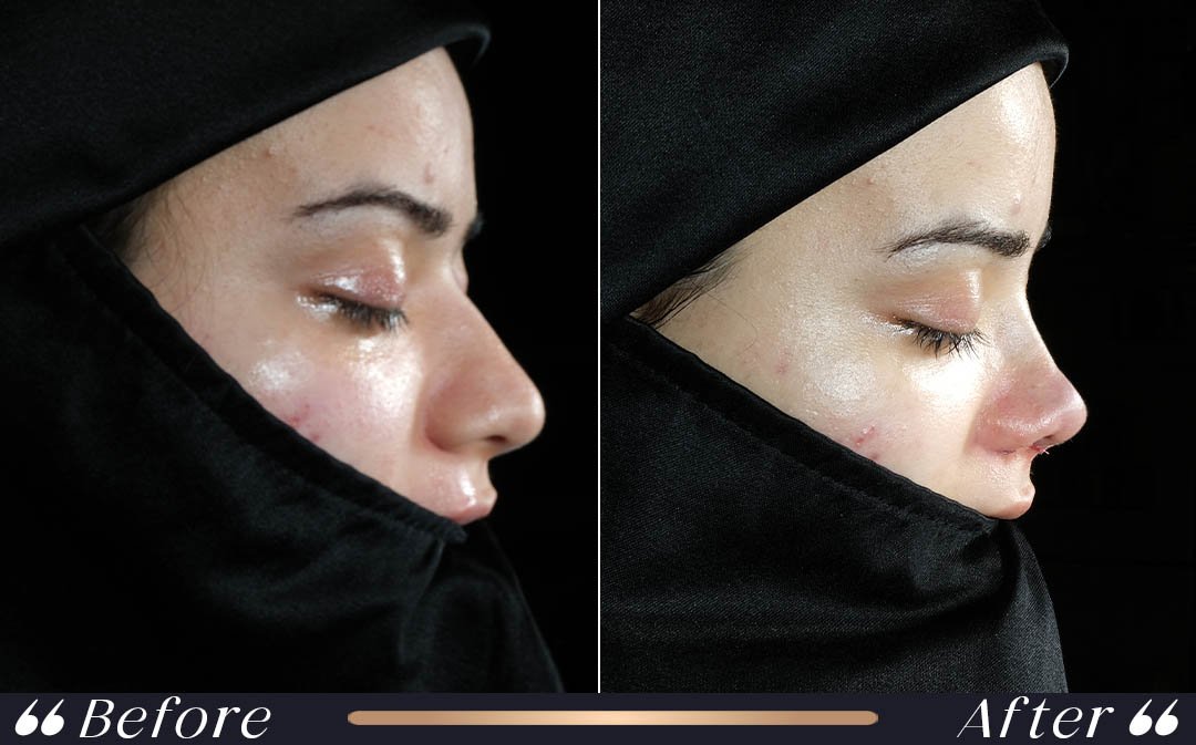 Rhinoplasty Tip Swelling how long does rhinoplasty swelling last nasal tip swelling