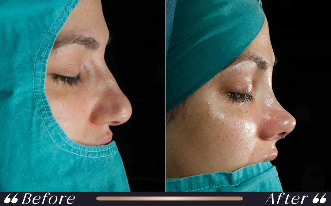 How Long Does Rhinoplasty Swelling Last how long does rhinoplasty swelling last at Yesilkoy Clinic