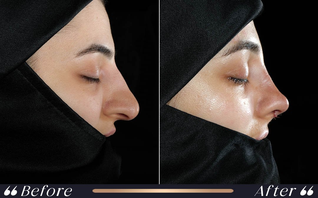 Rhinoplasty First Week Results turkey nose job before and after first week recovery