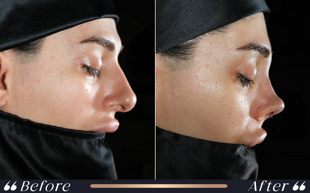 Turkey Nose Job Before and After turkey nose job before and after at Yesilkoy Clinic
