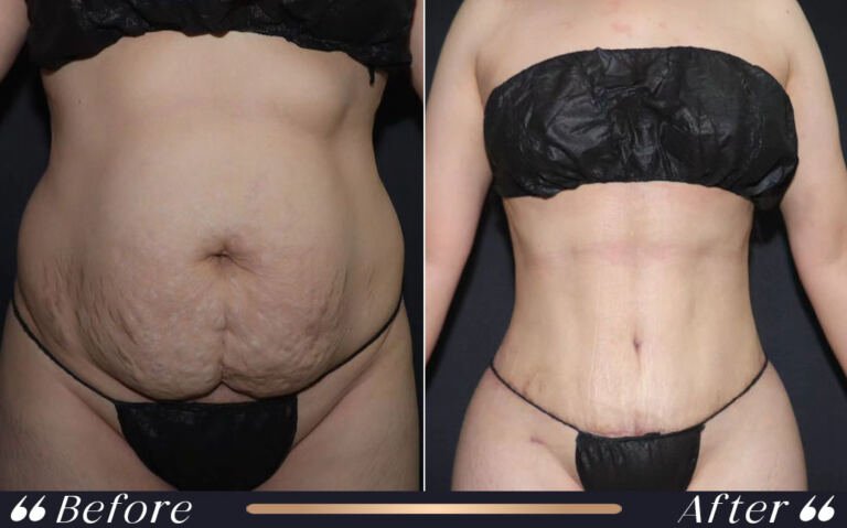 tummy_tuck