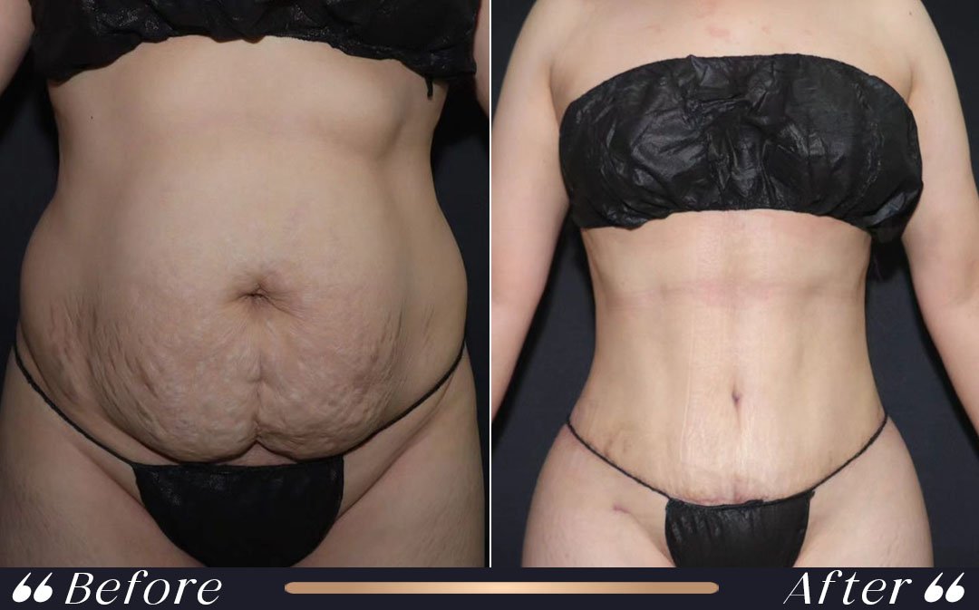 Liposuction vs Tummy Tuck liposuction vs tummy tuck comparison at Yesilkoy Clinic