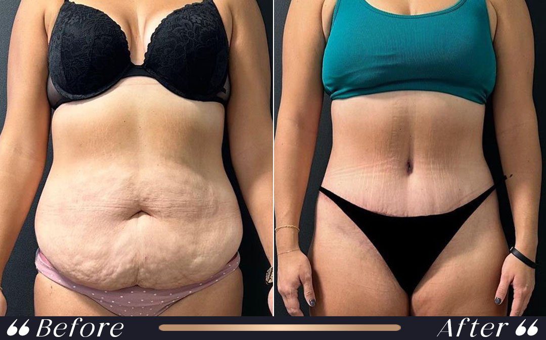 Tummy Tuck Abdominoplasty tummy tuck procedure in liposuction vs tummy tuck comparison