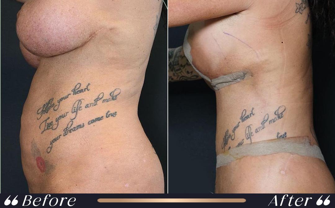 Tummy tuck recovery scar healing and final results Yeşilköy Clinic