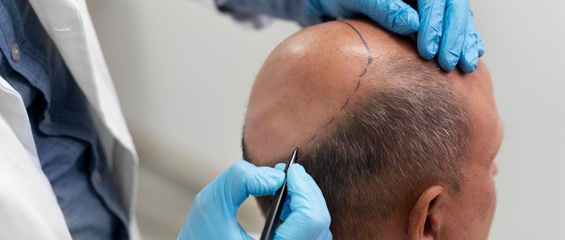 Hair transplant in summer at Yesilkoy Clinic in Istanbul