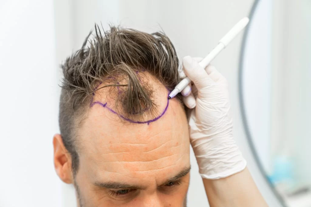 Hair transplant consultation at Yesilkoy Clinic Istanbul