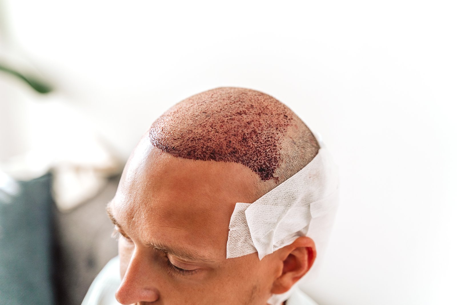 Summer hair transplant recovery and scalp aftercare