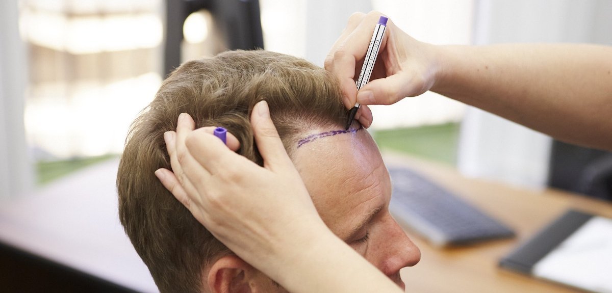 FUE and DHI hair transplant planning at Yesilkoy Clinic