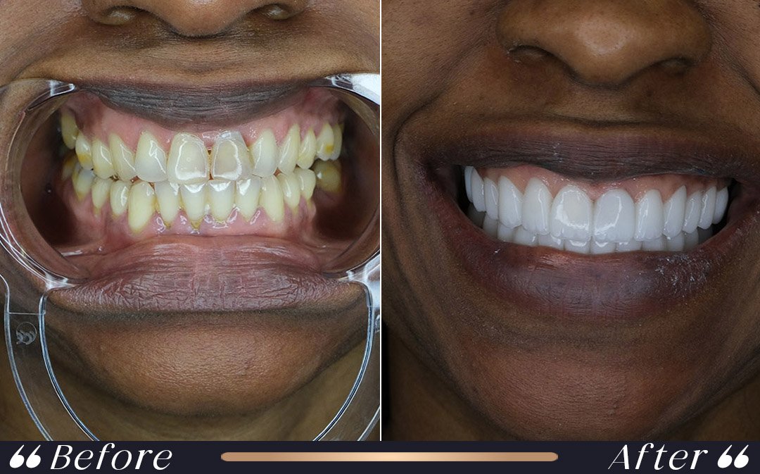 Veneers vs Zirconium Crowns Differences veneers vs zirconium crowns dental treatment differences